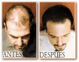 20060525175550-antes-despues.jpg
